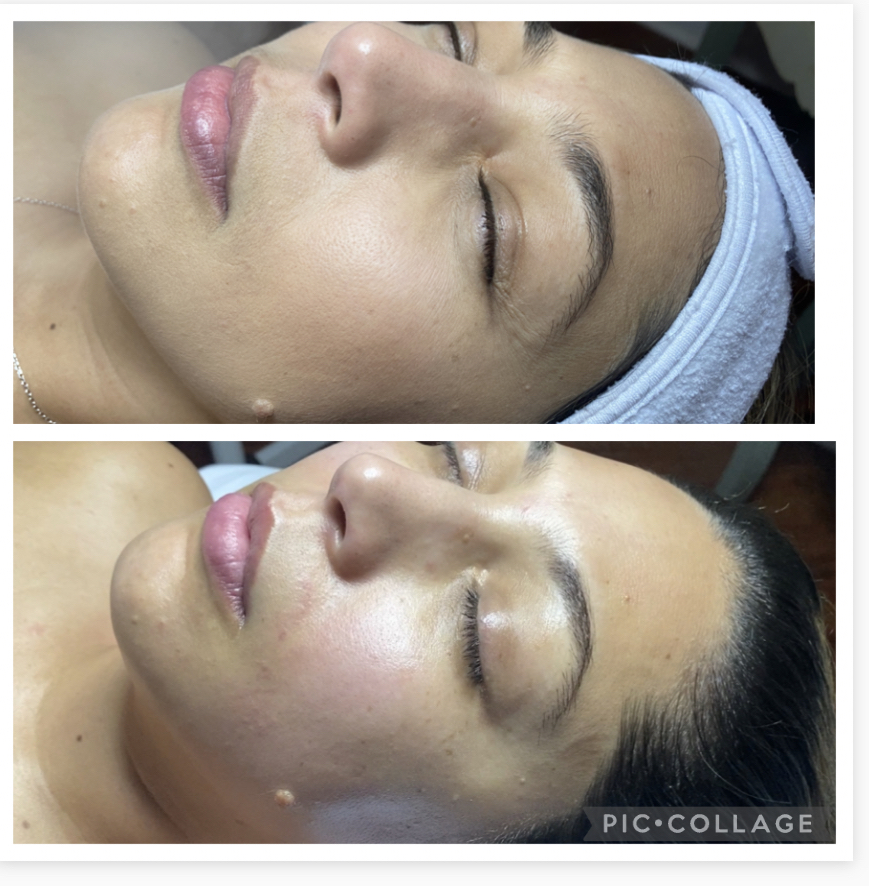 Sculpting And Lifting Facial