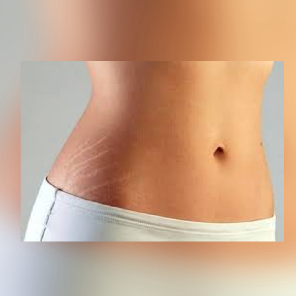 Micro-Needling StretchMarks