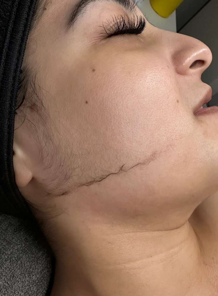 Dermaplaning