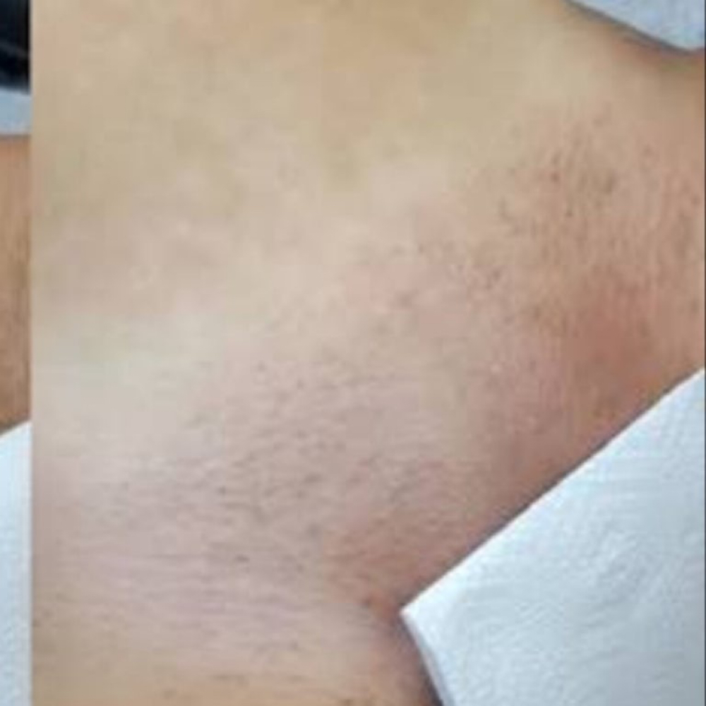 BRAZILIAN at celi esthetics in Smithtown, NY