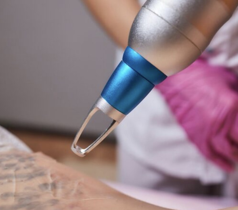 Laser Tattoo Removal
