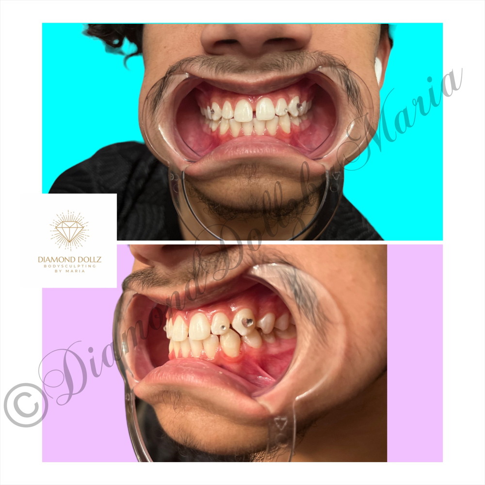 Tooth Gems 💎 ( 2 Gem Special)