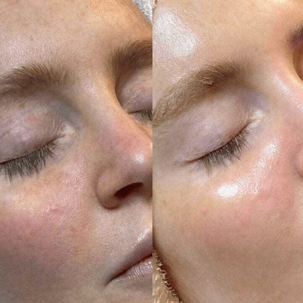 Beginner Chemical Peel at Made New Aesthetics in Lone Tree, CO
