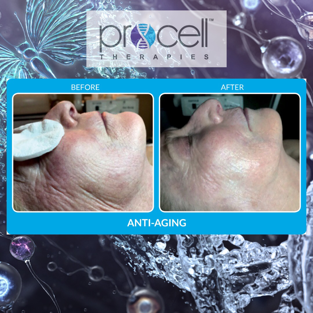 Procell Deluxe Face And Neck