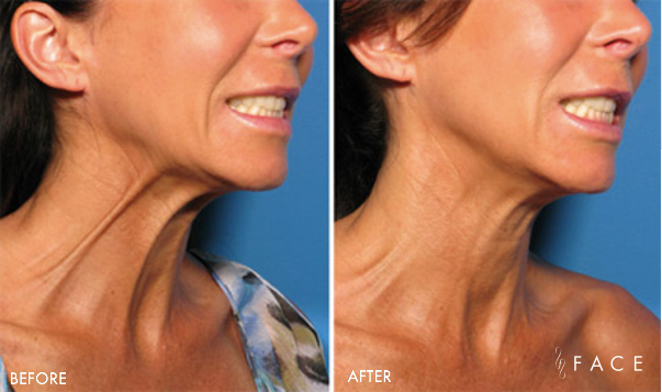 Nefertiti Neck Lift Series! at Flawesome Faces in Portage, IN