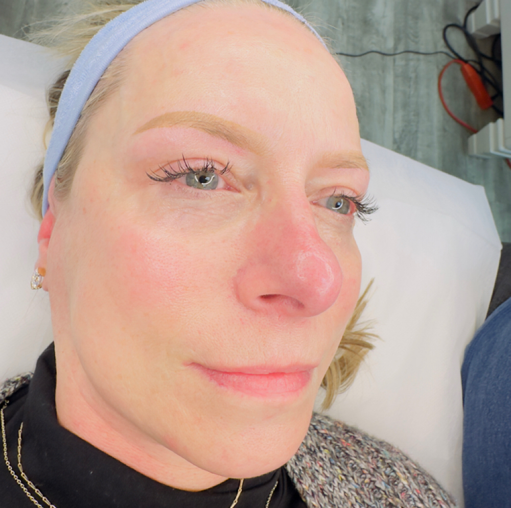 Nano Infusion at Flawless Beauty by Alicia in Palatine, IL