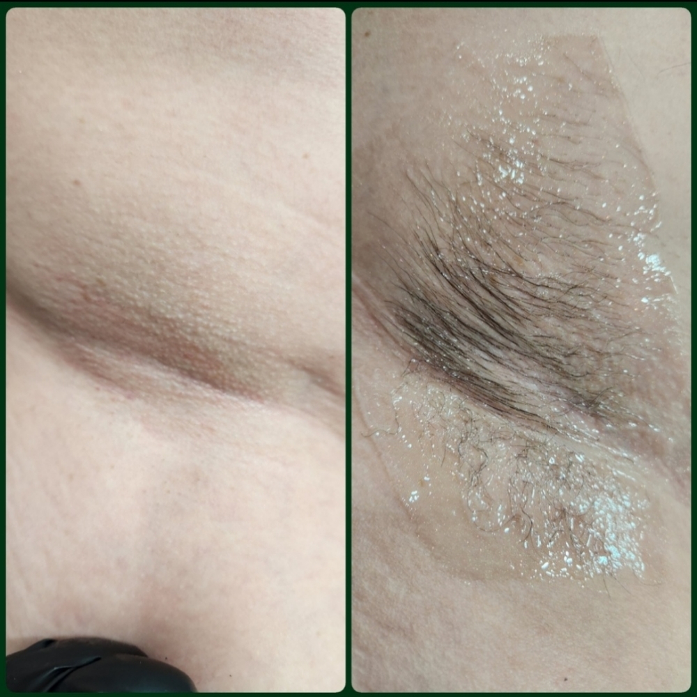 Underarms at Evermore Esthetics in Gravette, AR