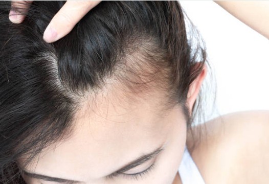 Hair Loss telehealth Consultation