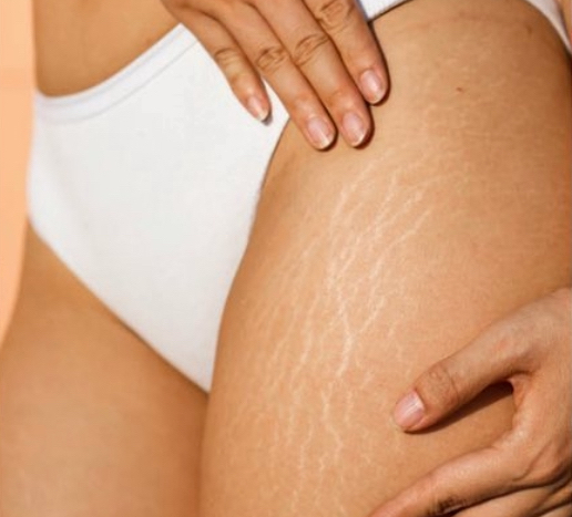 Inkless Stretch Mark Rejuvenation