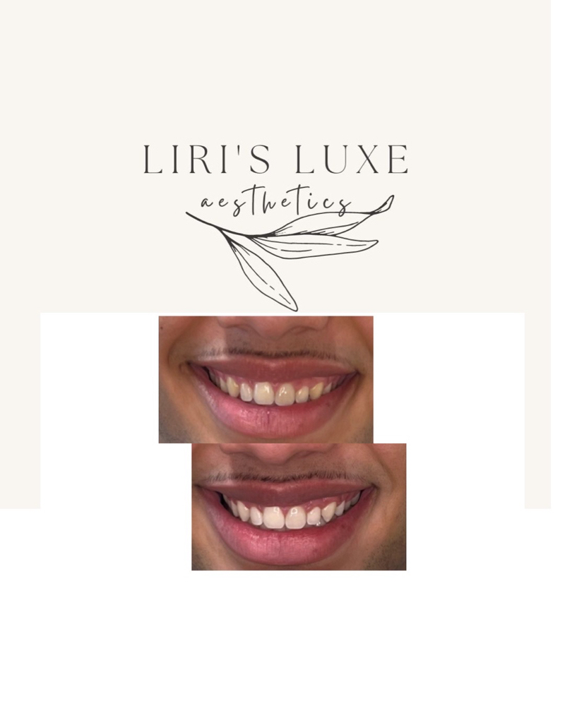 1 Hr. Teeth Whitening