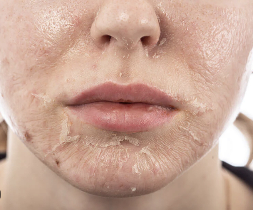 Chemical Peel ( 6 Series)