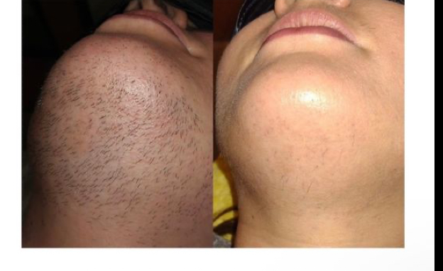 Chin Wax