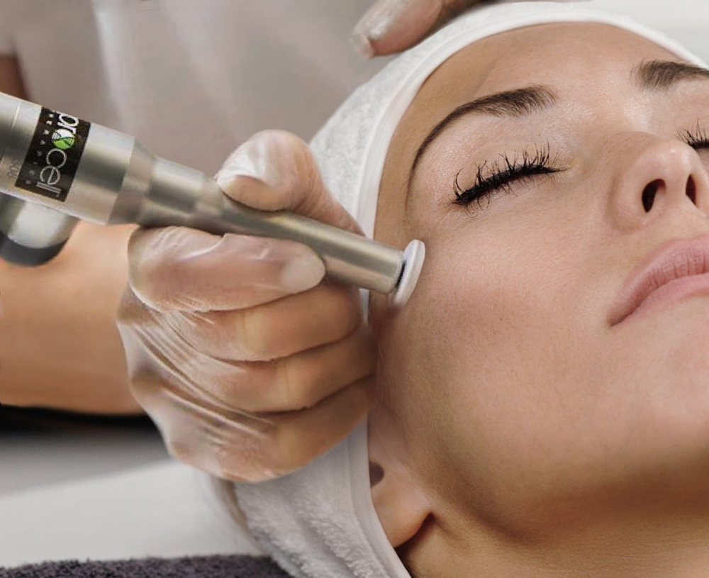 Microchanneling-Collagen Induction