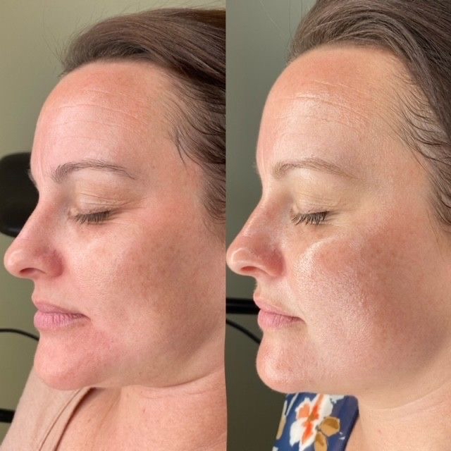 Chemical Peel Level 2
