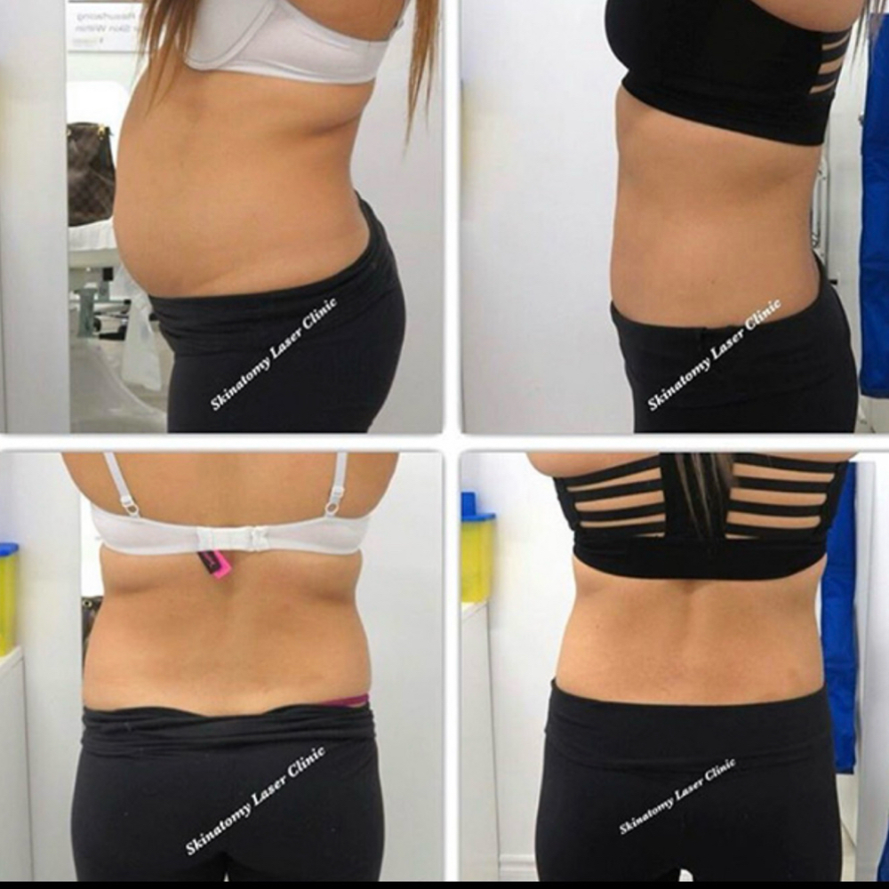 Liquid Lipo at ReBourne Aesthetics and Wellness in Ridgland, MS