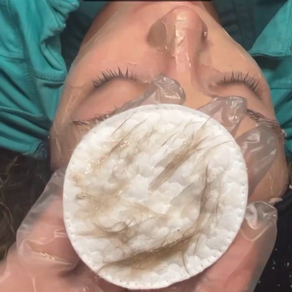 DERMAPLANE FACIAL at The Joint Aesthetics in PORT SAINT LUCIE, FL