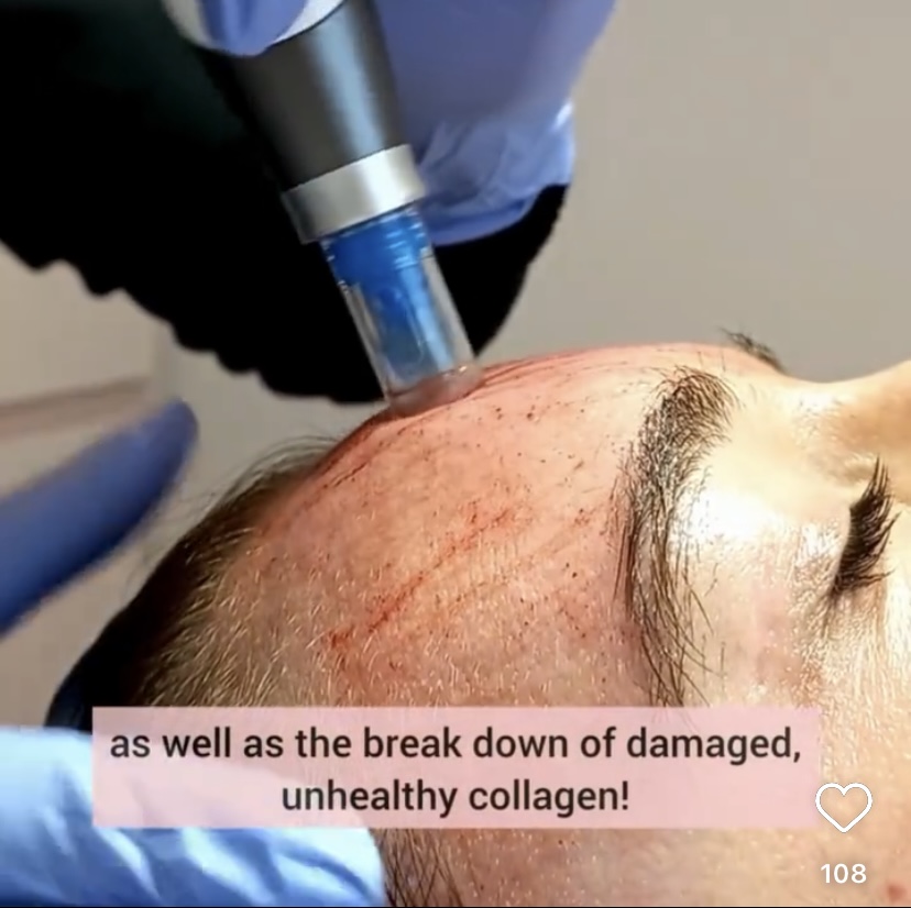Microneedling Facial