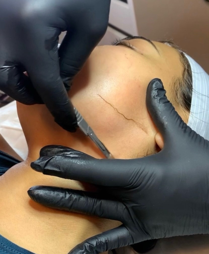 Demaplaning Facial at Anointed Aesthetics in Pasadena, TX