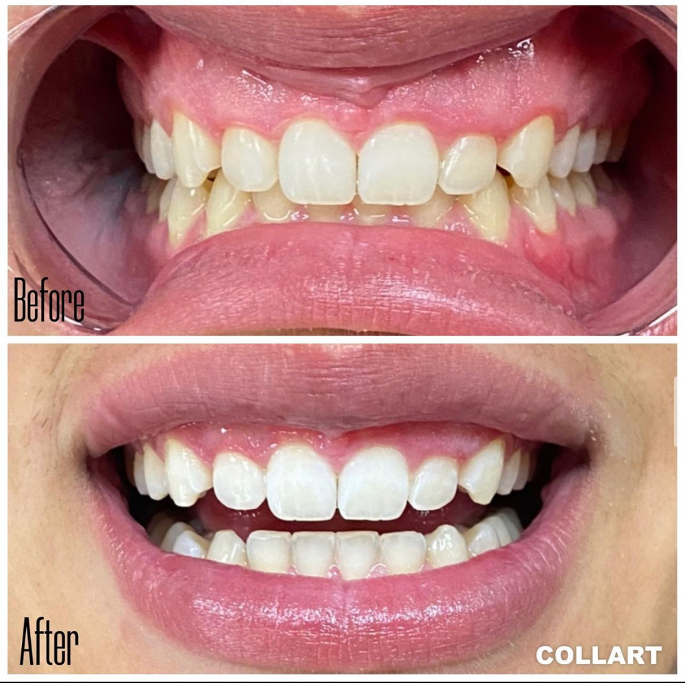 90 Min Teeth Whitening