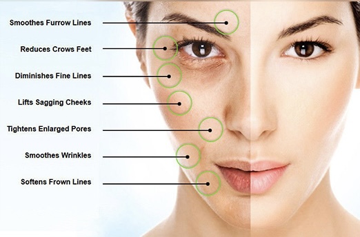 Microneedling Facial