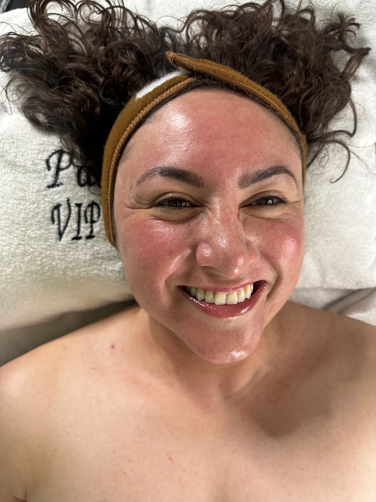 Glow Peel✨