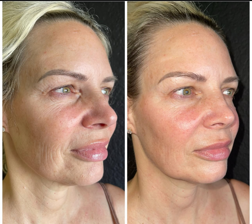 FACELIFT