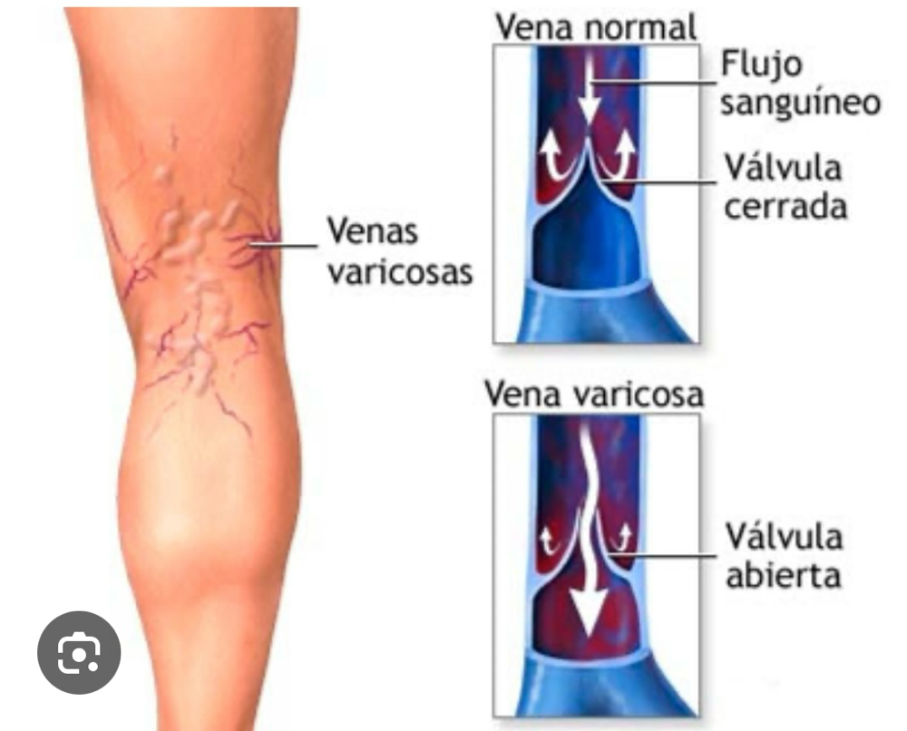Tratamiento Venas at Dream Body Esthetic in Orlando, FL