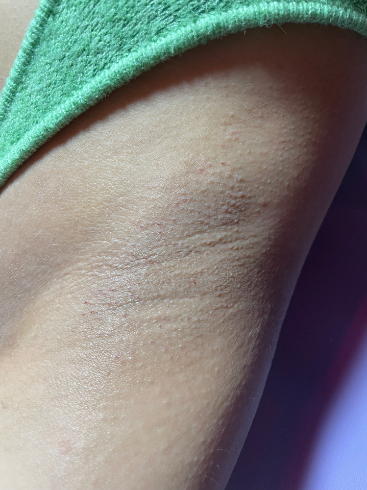 Underarms