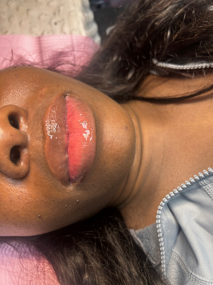 NEEDLE-LESS Fillers .5Ml