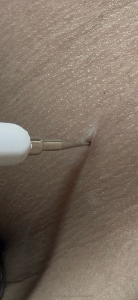 Skin Tag Removal