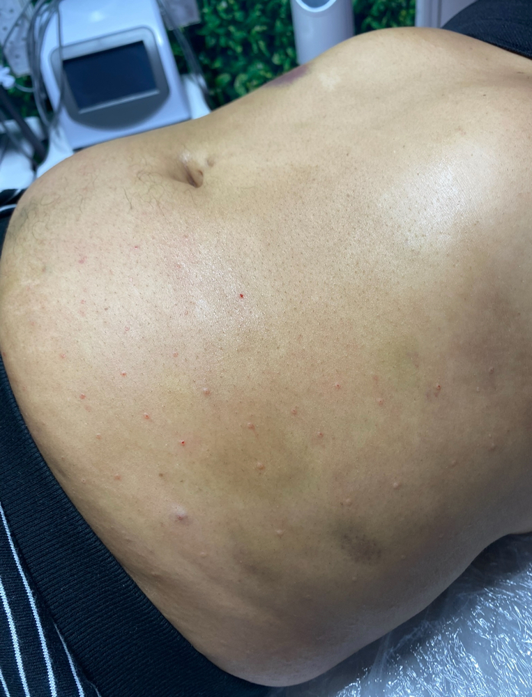 Fat Dissolve Upper Abdomen