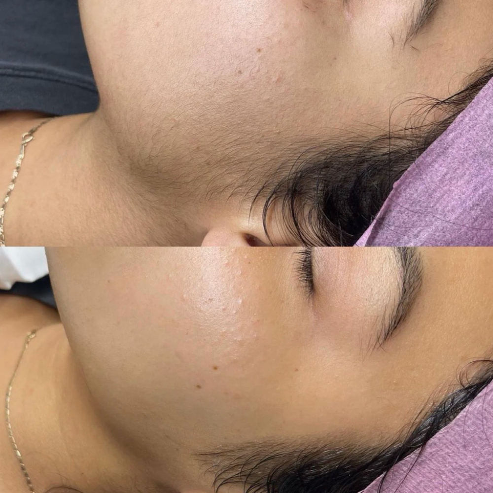 Foyology Dermaplaning Treatment at Fountain of Youth Spa in Yuma, AZ