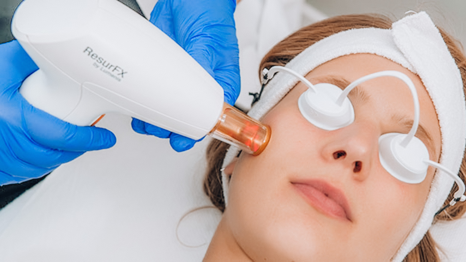 Resurfx or PhotoFractional Laser