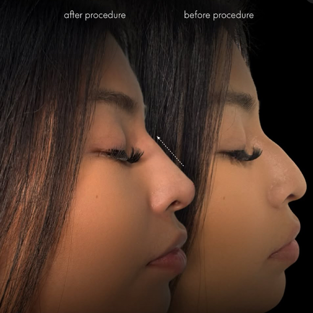 Nose Snatch at Aesthetics by Amina in New York, NY