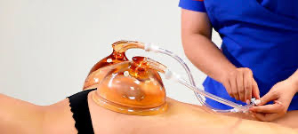 Hamstrings Fat Melt W BBL Cupping