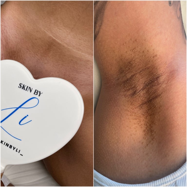 Brazilian & Underarm Wax at Skin by Li LLC in Manchester, CT