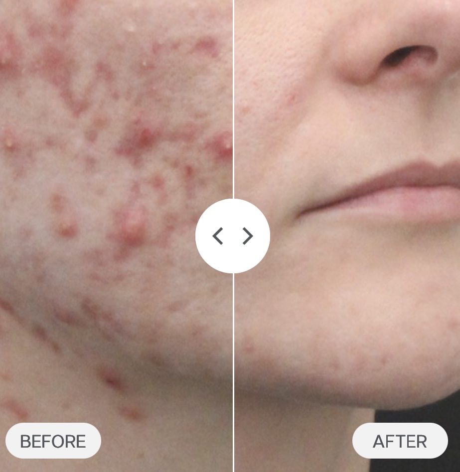 Clear Skin Method™