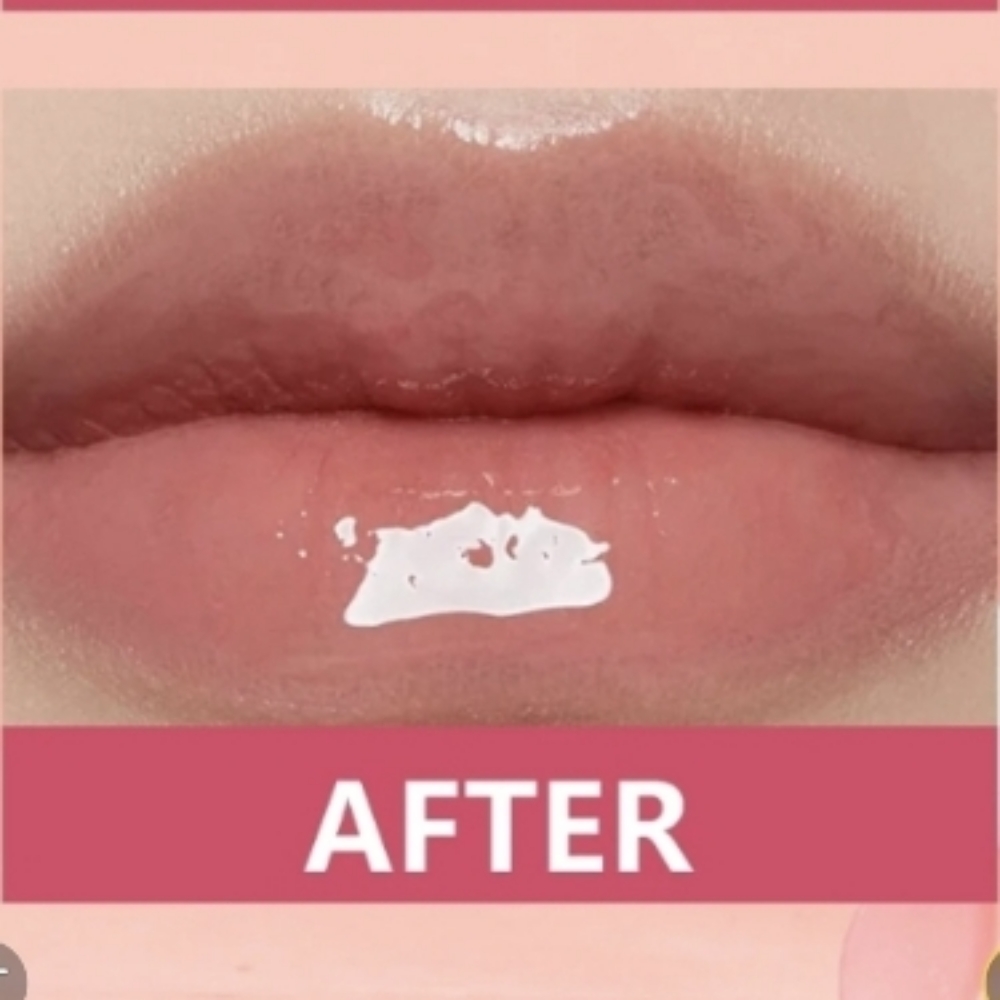 Hyaluronic Acid Lip treatment at Sun Skincare LLC in Scottsdale, AZ