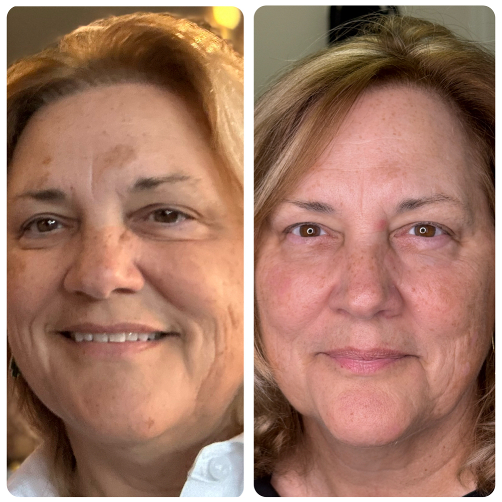 Cryo Pen Precision Spot Correction at Tranquil Oasis Spa in Bradenton, FL
