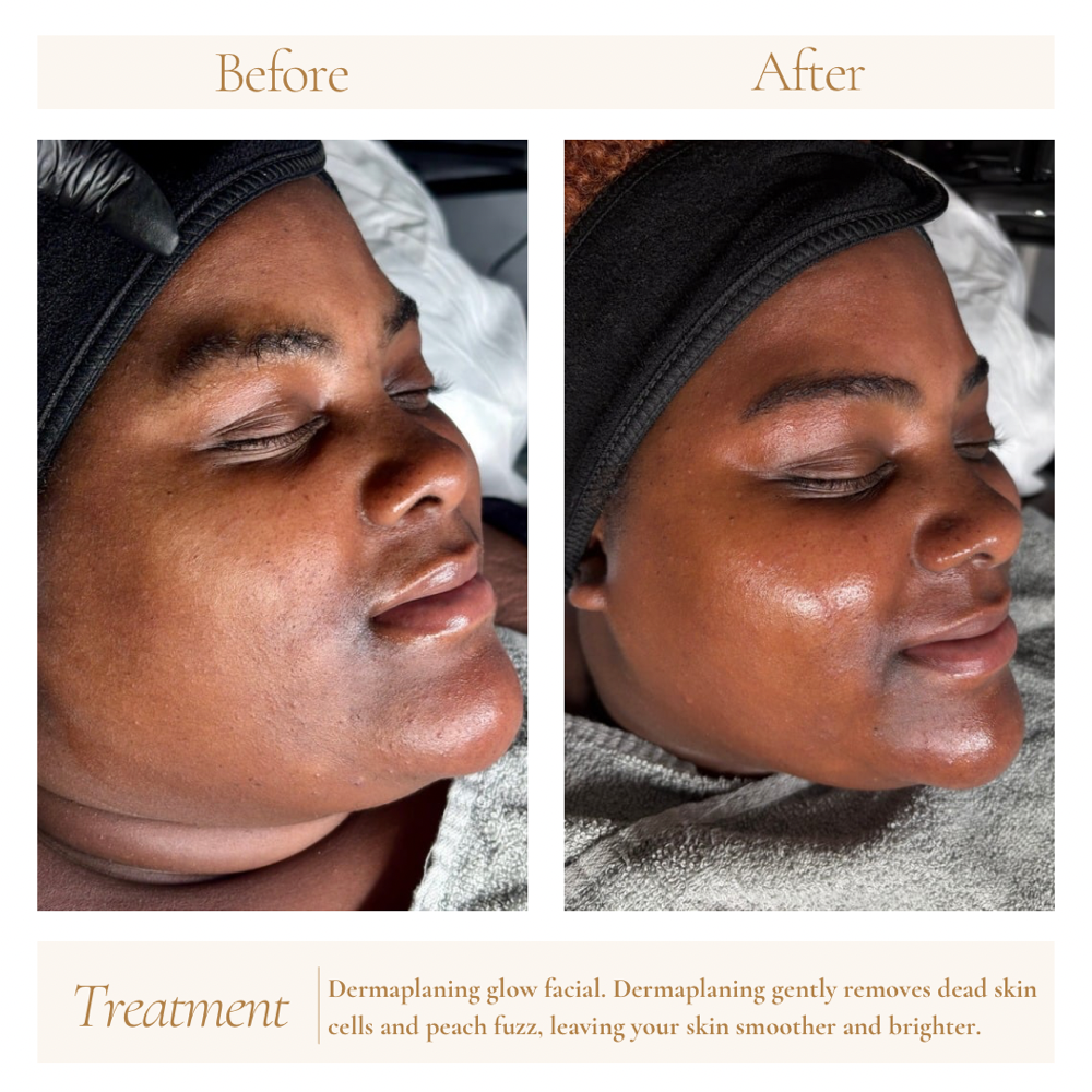 ✨ Dermaplaning Glow Facial ✨