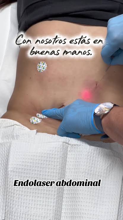 HIFU ABDOMEN at Natural Glow in Grand Praire, TX