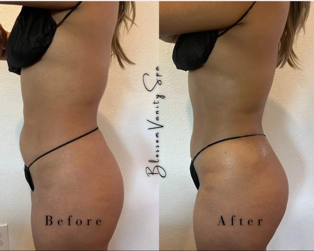 Lipo 360( Stomach + back) at Blossom Vanity Spa in Missouri City, TX