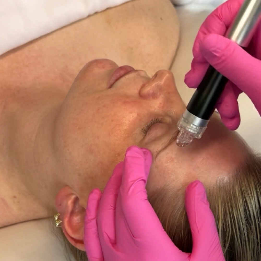 Poplar Deluxe Hydrofacial at Sam W Aesthetics in Florence, AL