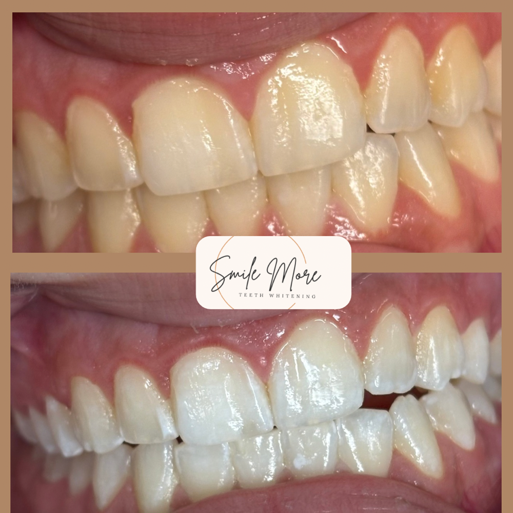Teen Whitening 14-17 Years Old