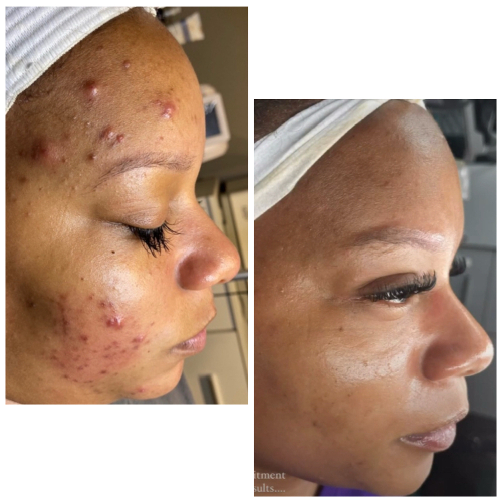 Skin Therapy Program