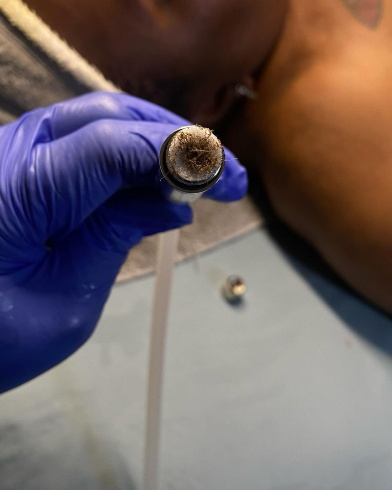 Microdermabrasion