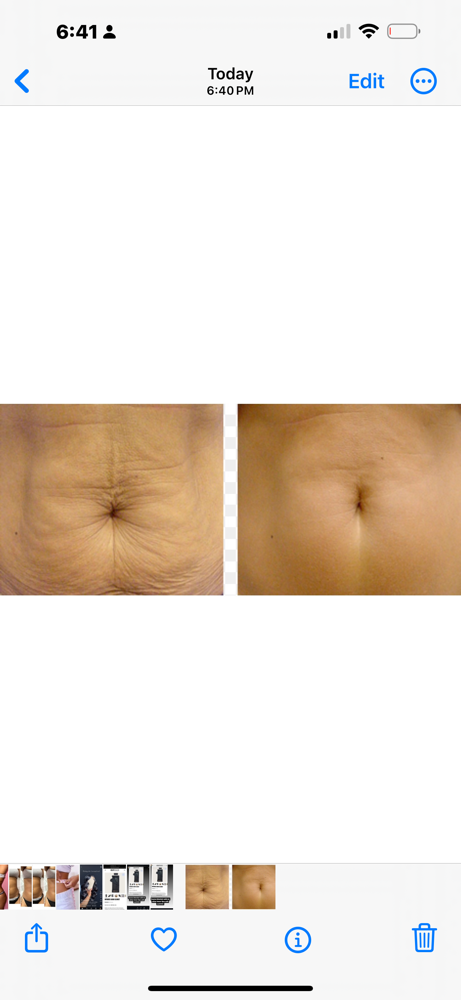 Skin Tighting Stomach/back at Eygptian Esthetics in Upper Marlboro, MD