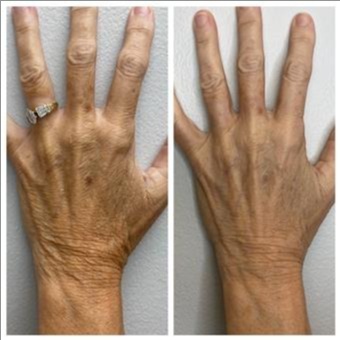 Tixel Antiaging hand treatment at Marco Island Aesthetics