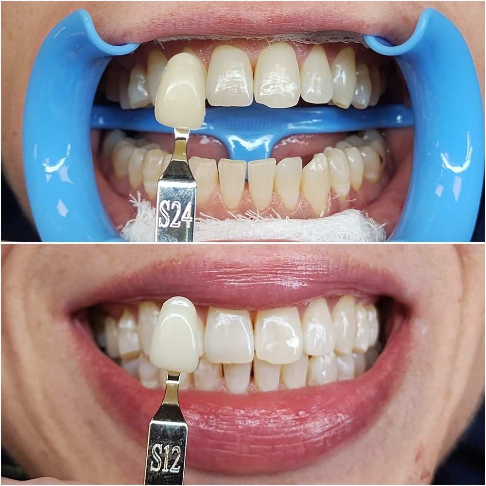 1 Hr Teeth Whitening at JA Beauty & Skin in Kansas City, MO