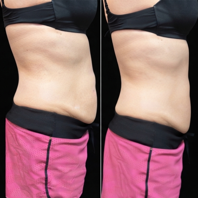 Back-to-School Sculpt Package ✨ at THE TOX LOUNGE in Terrell, TX